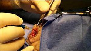 Аденома гепатоидных желез Фото