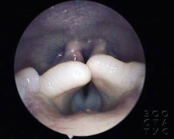 брахицефалический синдром