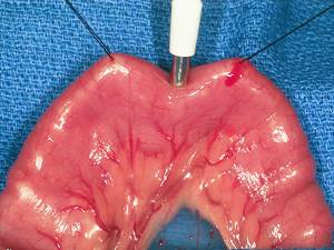 Биопсия Фото