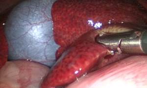 Биопсия Фото