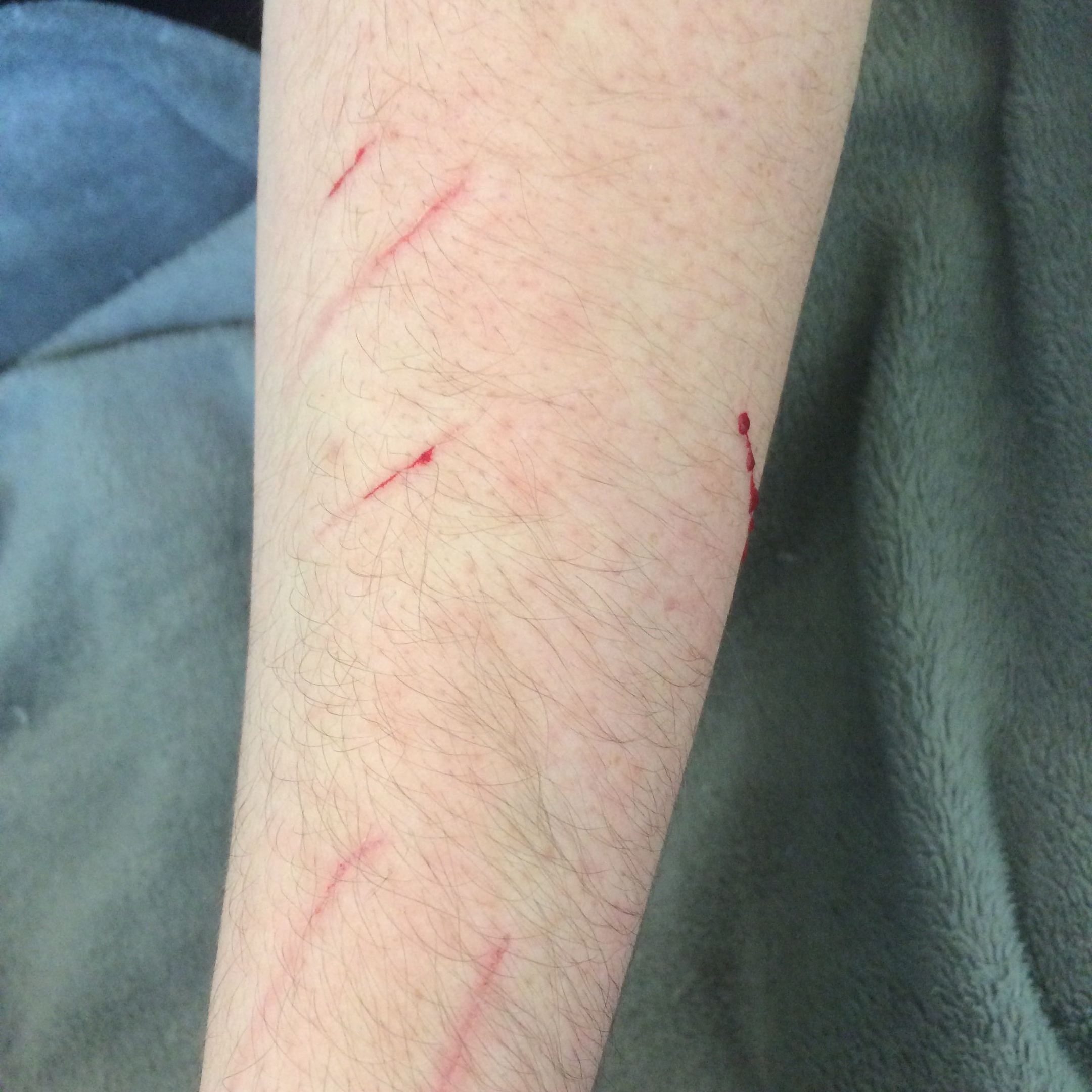 Фелиноз Фото болезнь кошачьих царапин