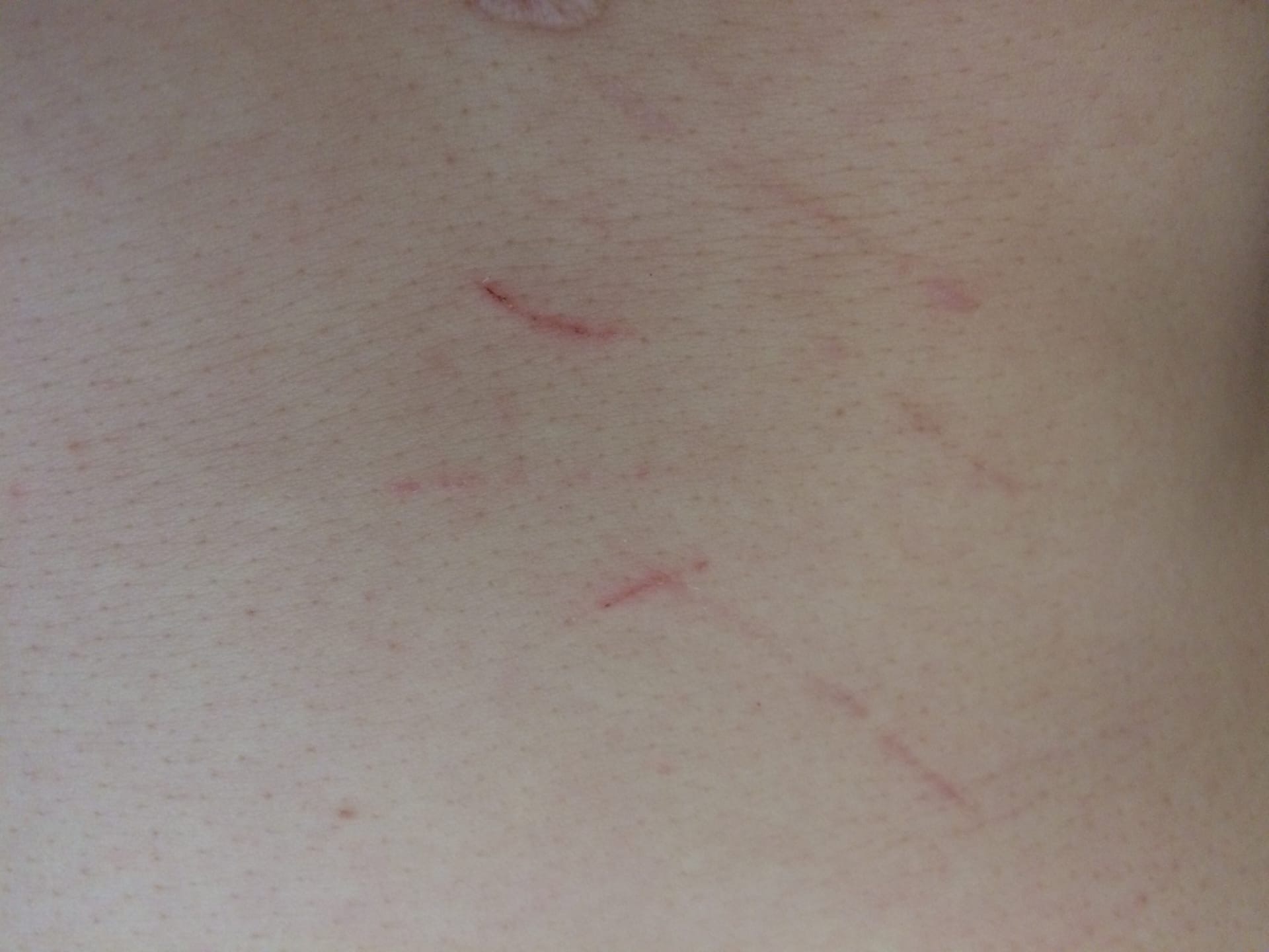 Фелиноз Фото болезнь кошачьих царапин