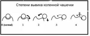 Степени вывиха коленной чашечки Фото