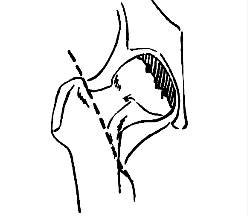 Резекция головки бедра Фото