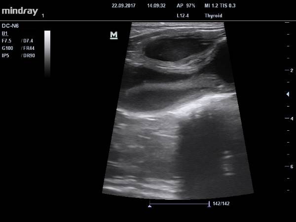 УЗИ пиометры у кошки
Фото пиометра у кошек - узи